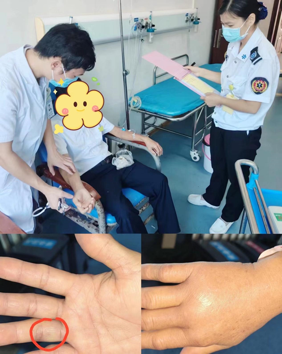 乐东县第二人民医院成功构建毒蛇咬伤急救体系