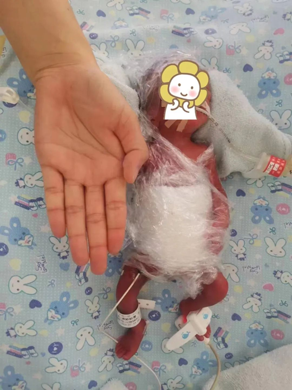 海南省人民医院成功救治省内最小胎龄早产儿