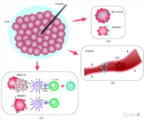 海医一附院完成肝癌冷热复合式消融治疗