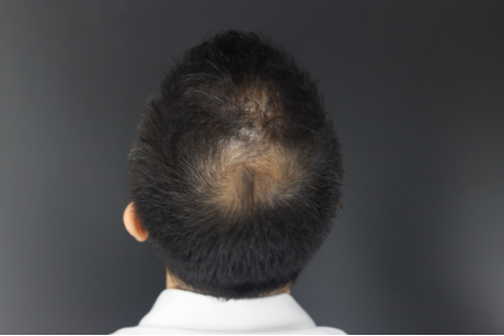 治疗脱发又一“神器” A型肉毒毒素注射生发