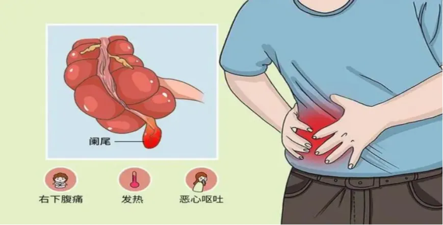 海医一附院成功实施内镜下逆行阑尾治疗术