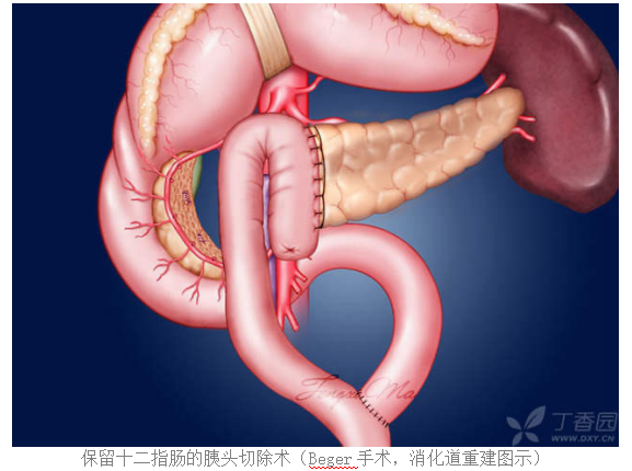 海南医科大学第二附属医院成功针对慢性胰腺炎患者实施医院首例荧光腹腔镜下保留十二指肠胰头切除术