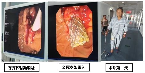 全省首例—内镜下胆管癌射频消融+金属支架植入术