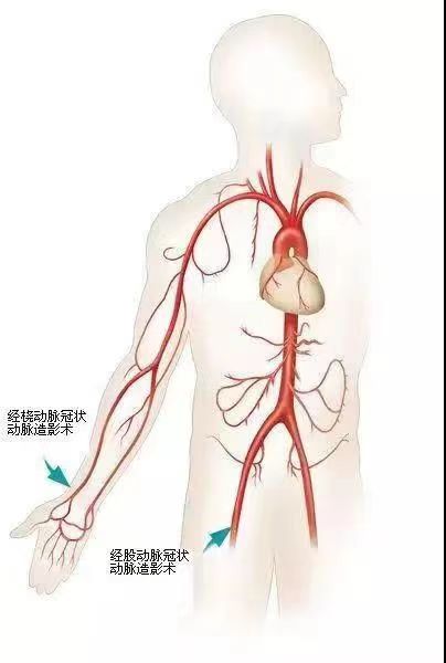 神经介入新技术：解放军总医院海南医院使用经桡动脉脑血管造影术让患者受益