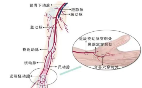 神经介入新技术：解放军总医院海南医院使用经桡动脉脑血管造影术让患者受益