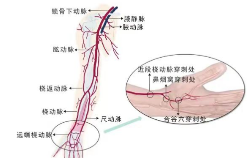 神经介入新技术：解放军总医院海南医院使用经桡动脉脑血管造影术让患者受益