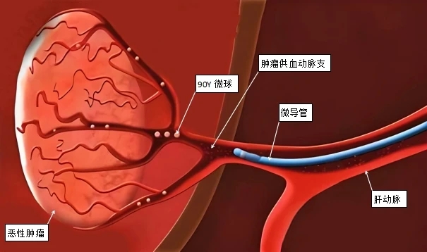 肝癌患者的福音！海南省人民医院独立完成2例肝癌钇90树脂微球治疗