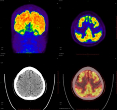 海南首例!“第二代Tau蛋白 PET/CT显像”在解放军总医院海南医院成功开展