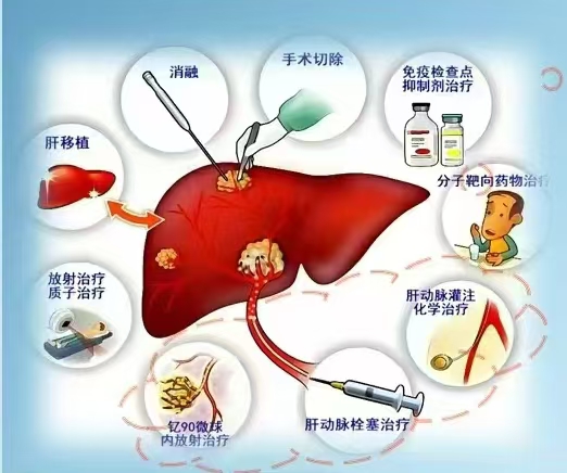 一站式就医  MDT聚力治疗复杂肝病患者——解放军总医院海南医院肝病多学科联合门诊开诊