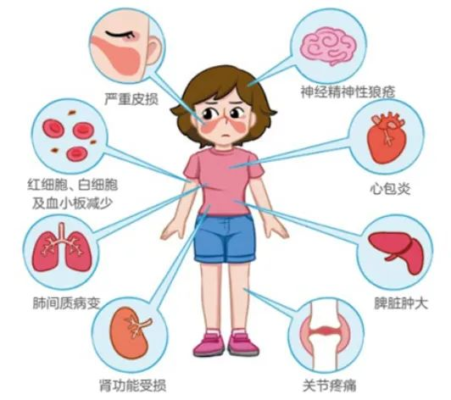 不死的癌症—重症狼疮患者重生之旅