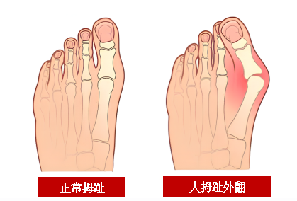 鞋不对，脚遭殃！海南医科大学第一附属医院成功实施华南首例微创拇外翻髓内板Spear Plate植入矫正术