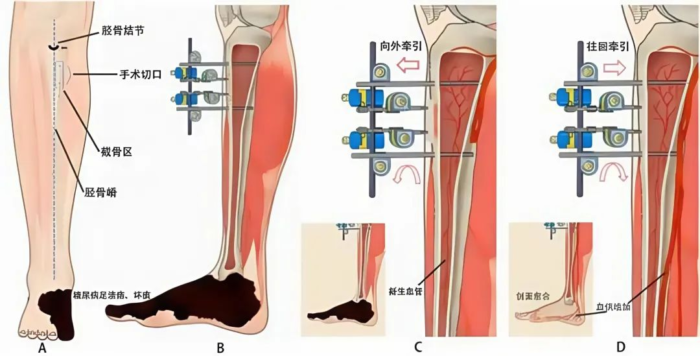 胫骨横向骨搬移术：糖尿病足患者的新希望